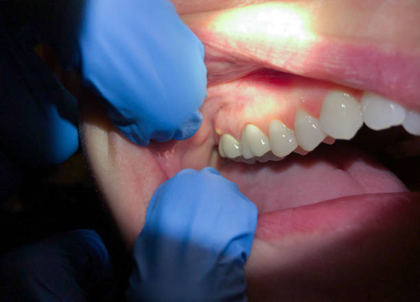 Best Emergency Dentist for Lost Fillings or Crowns in Emmaus, PA