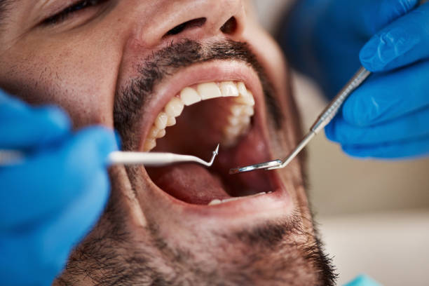 Best Emergency Dental Extractions in Emmaus, PA